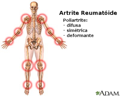 Artrite Reumatoide